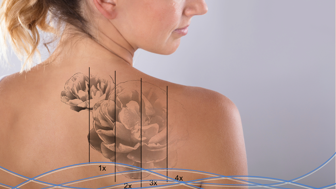 Rimozione Tatuaggi