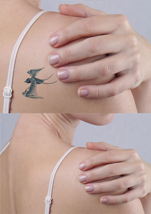 rimozione-laser-tatuaggi-roma