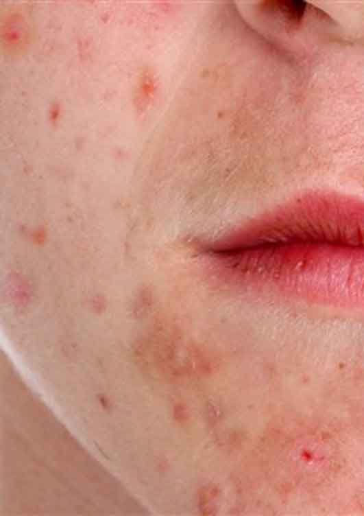 protocollo-trattamento-acne-attiva