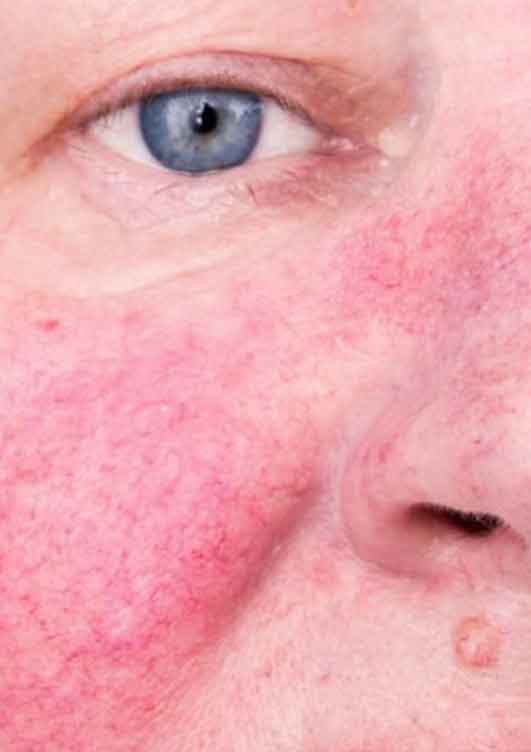 protocollo-trattamento-rosacea