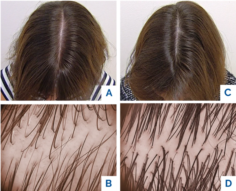 tricopat-risutlati-capelli-femminili