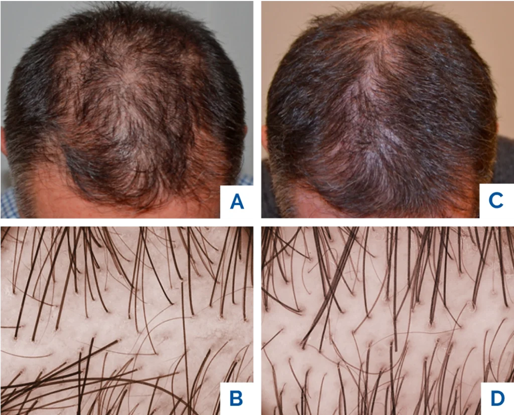 tricopat-risutlati-capelli-maschili